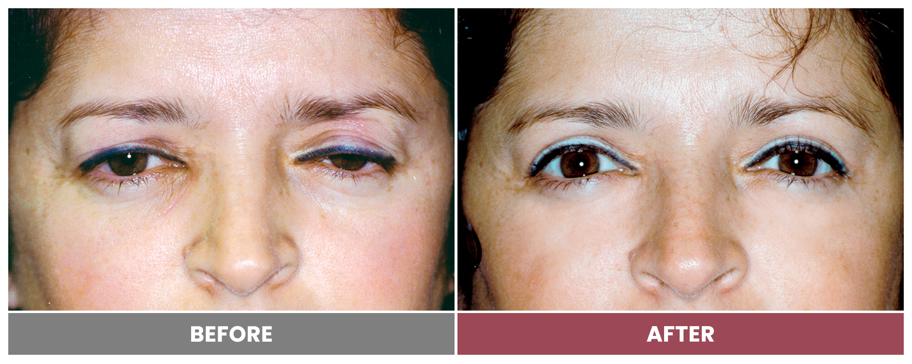 BLEPHAROPLASTY & PTOSIS REPAIR - Case 2